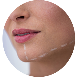 Face Surgery Procedures - Chin Augmentation