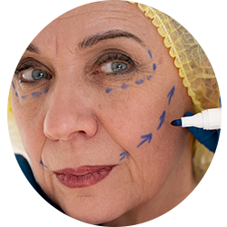 Face Surgery Procedures - Facelift